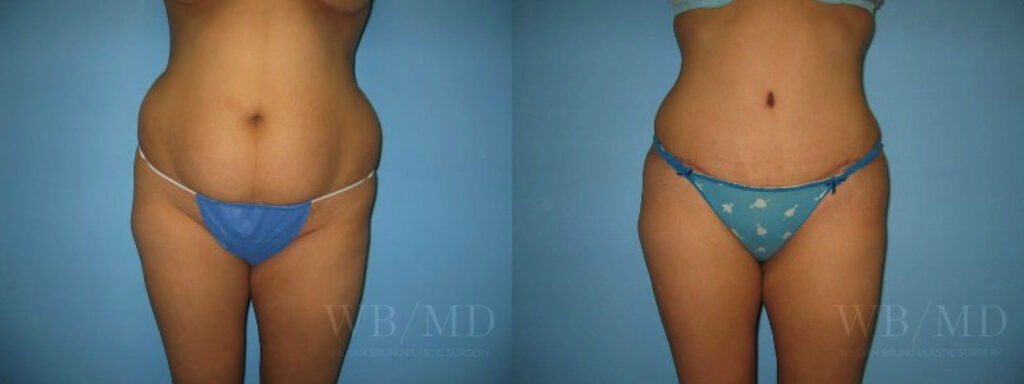 Williambruno assets beforeandafters 0021 tummytuck 8 a | william bruno plastic surgery | william bruno plastic surgery