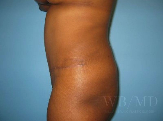| william bruno plastic surgery