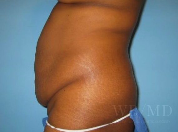 | william bruno plastic surgery
